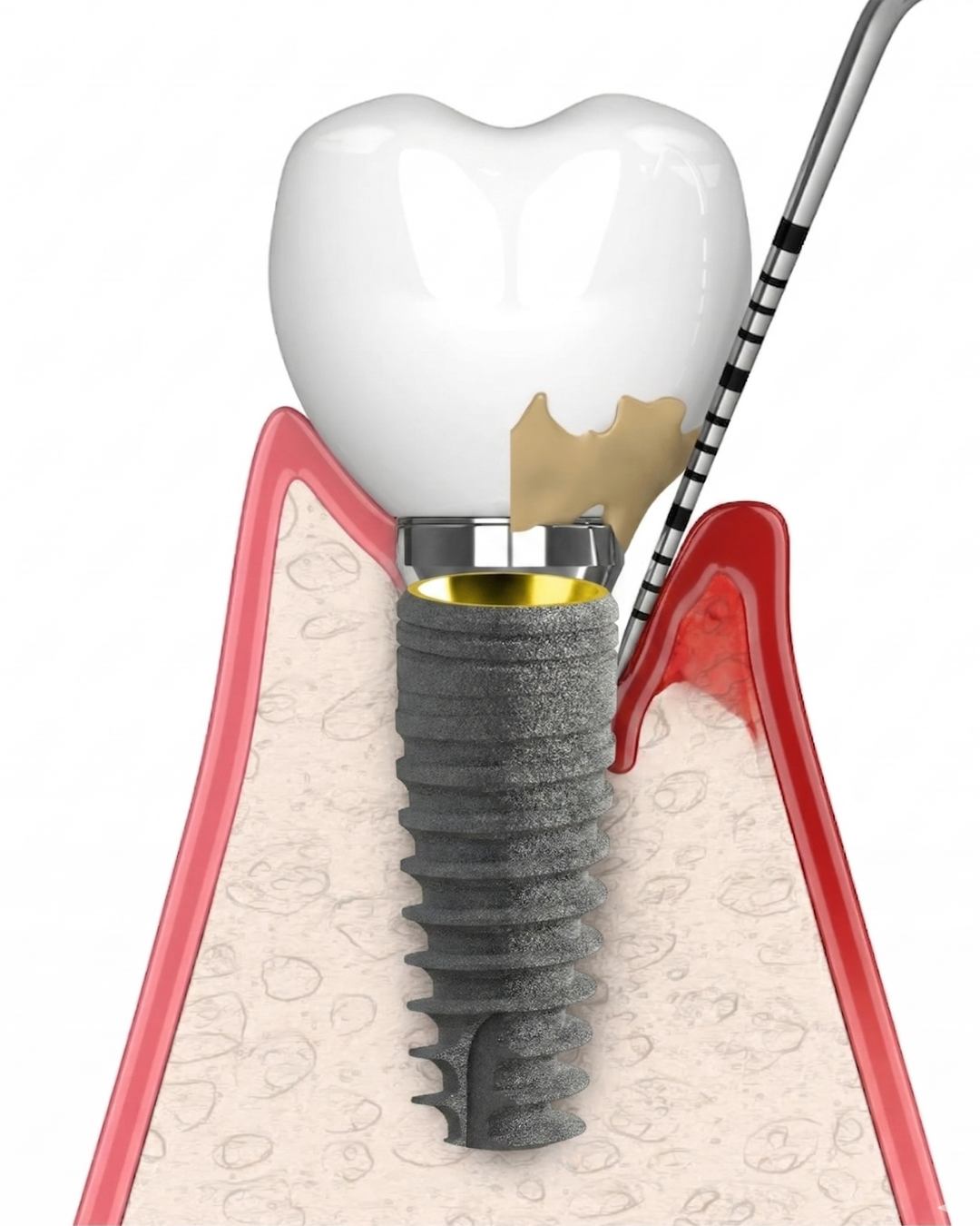 Fordent Medikal implant çözümleri